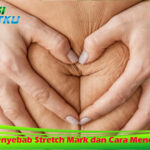 Ketahui Penyebab Stretch Mark dan Cara Mencegahnya